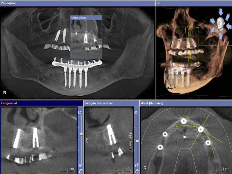 Cirurgia Guiada 3D para implantes