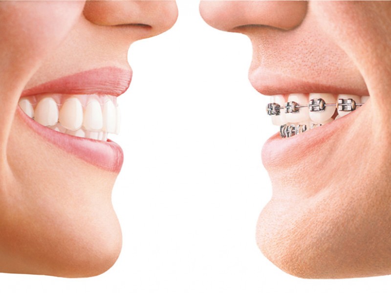 Ortodontia (Aparelhos Dentais)   