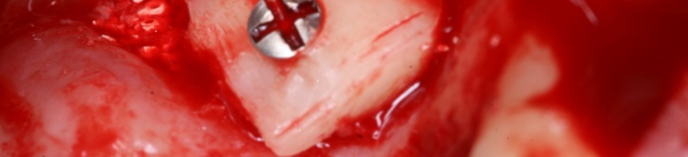 Enxerto de Osso para implante dental