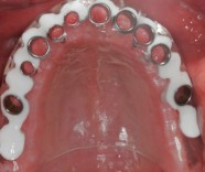Implante dentário guiado