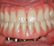 Dentadura fixa por implantes
