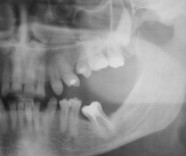 Exodontia de dentes supranumerário