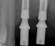 Implantes de dentes fixos
