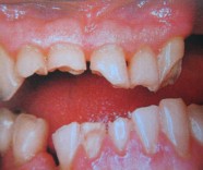 Desgaste dental causado por bruxismo