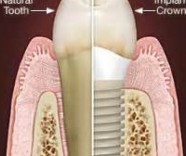 Implante dentário
