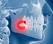 Terceiro molar ou dente do siso 