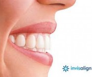 Aparelho dentário invisivel