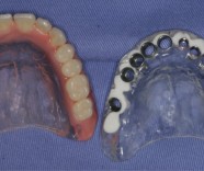 Implante dental sem corte. 