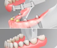 Prtese fixa protocolo sobre implante dentário
